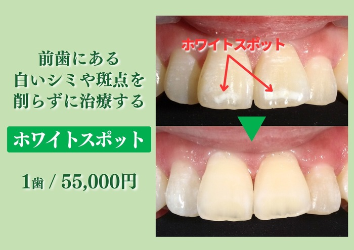 ホワイトスポット治療