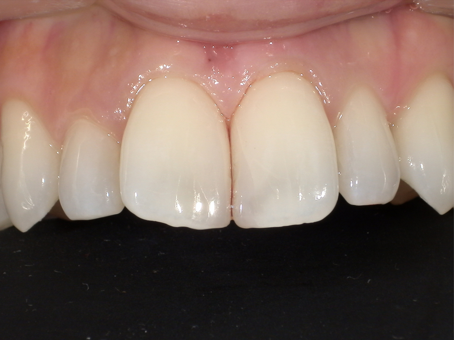 ダイレクトボンディング_30代女性_治療後