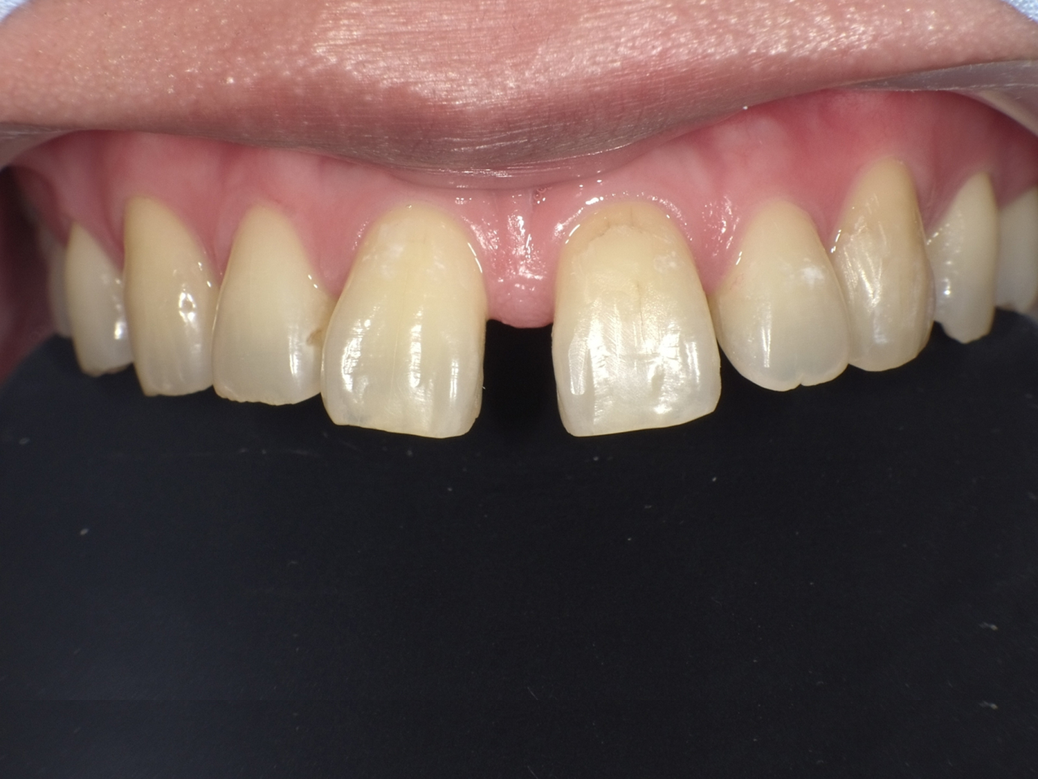 ダイレクトボンディング_30代女性_治療前