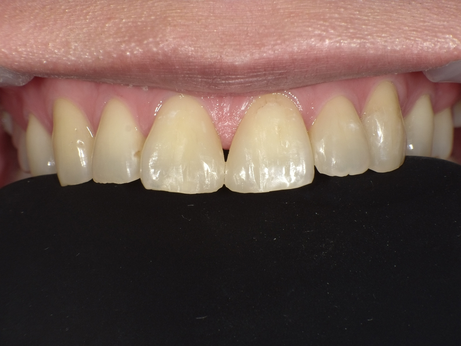 ダイレクトボンディング_30代女性_治療後