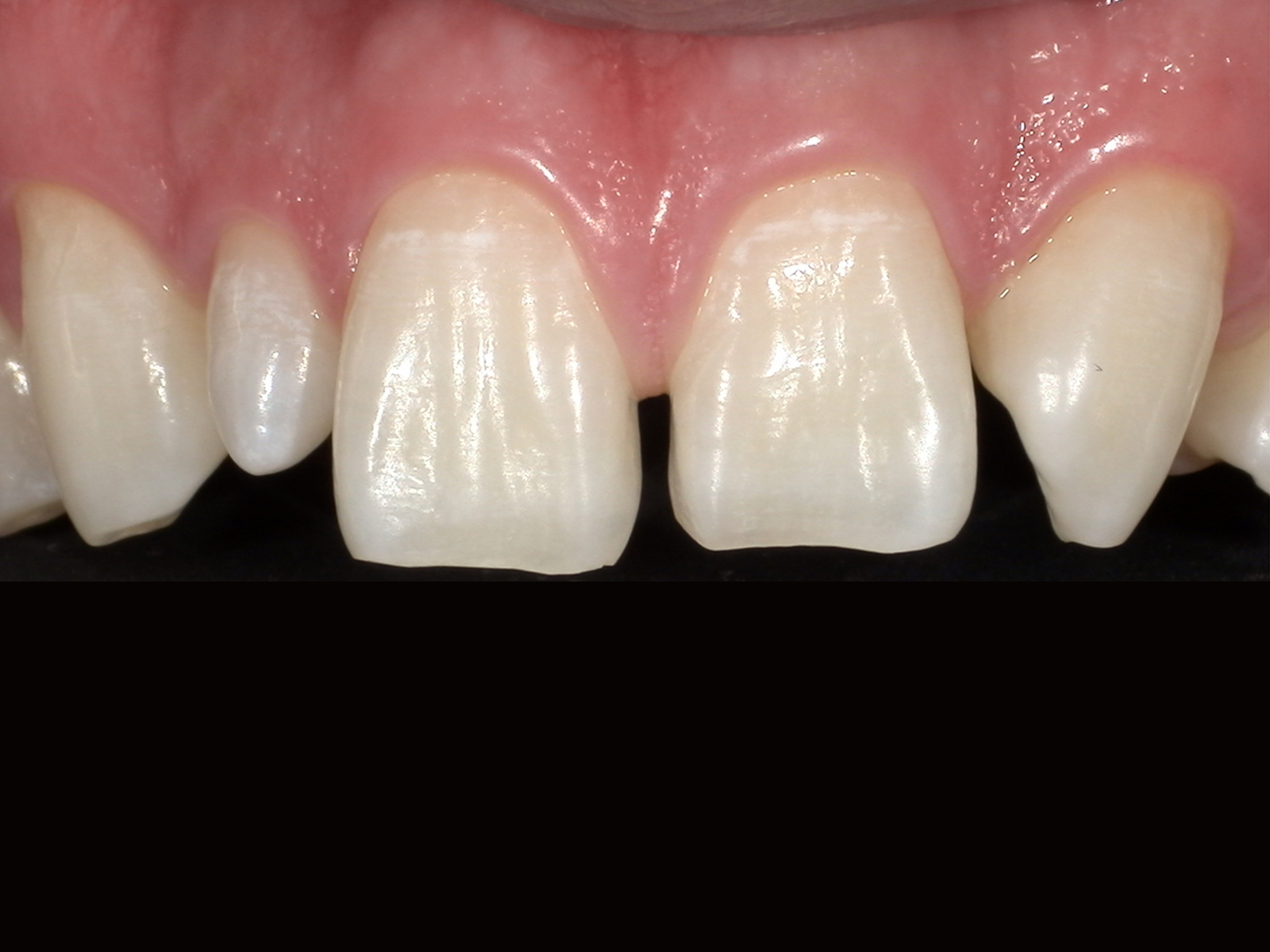 ダイレクトボンディング_20代男性_治療前