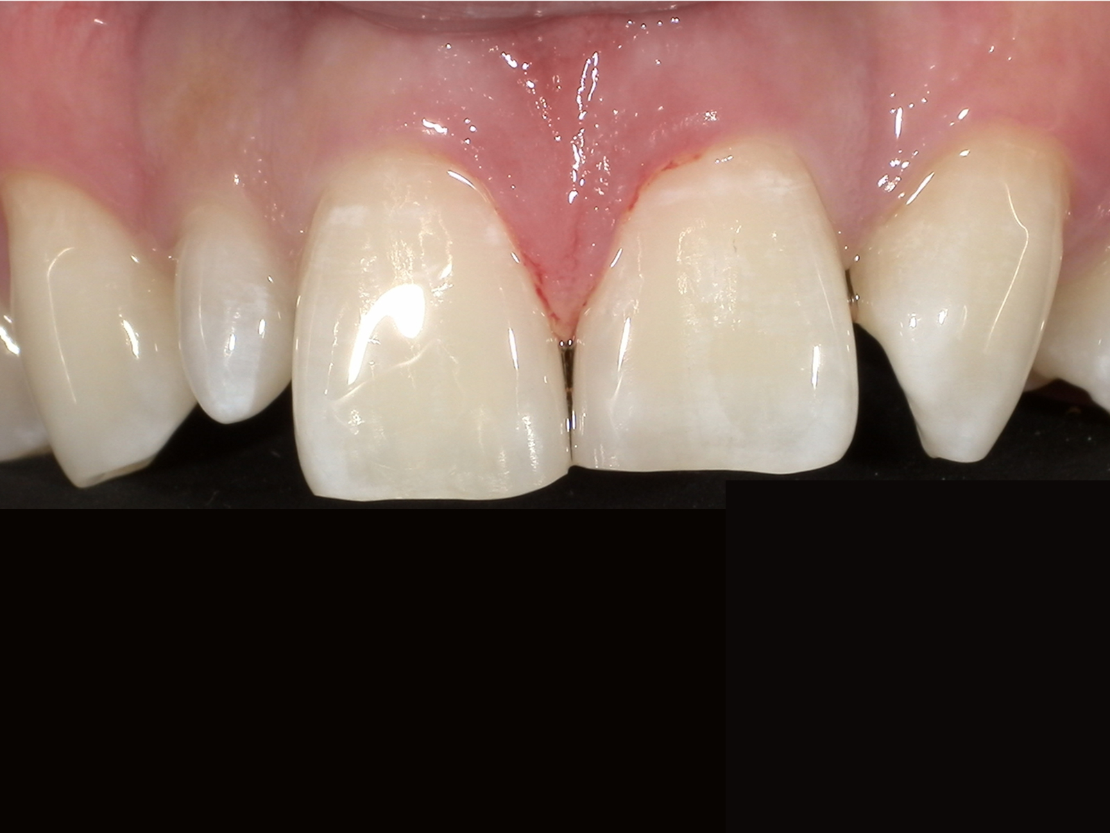 ダイレクトボンディング_20代男性_治療後