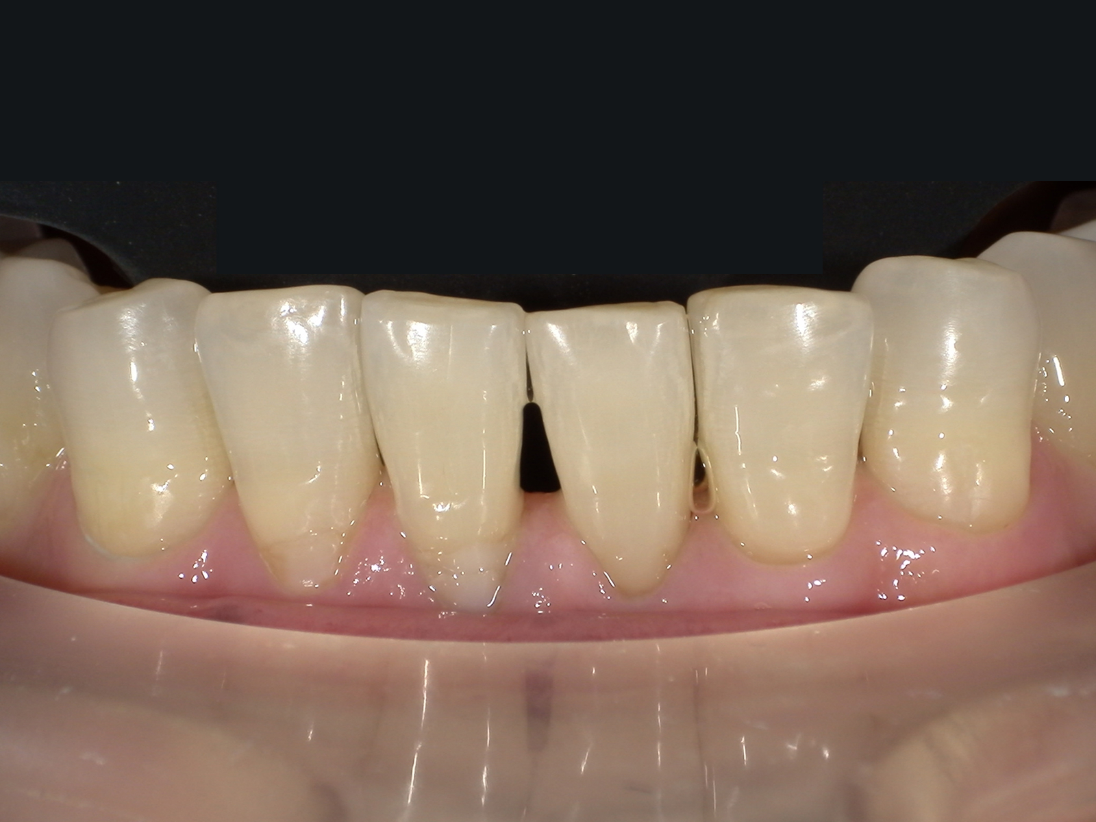 ダイレクトボンディング_60代女性_治療前