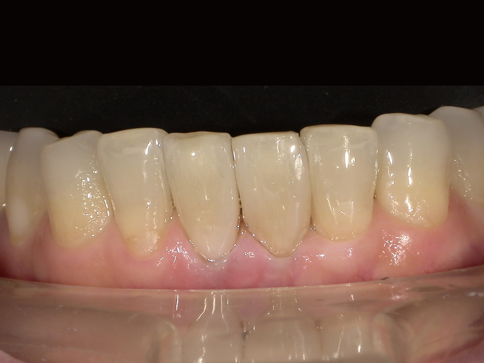 ダイレクトボンディング_60代女性_治療後