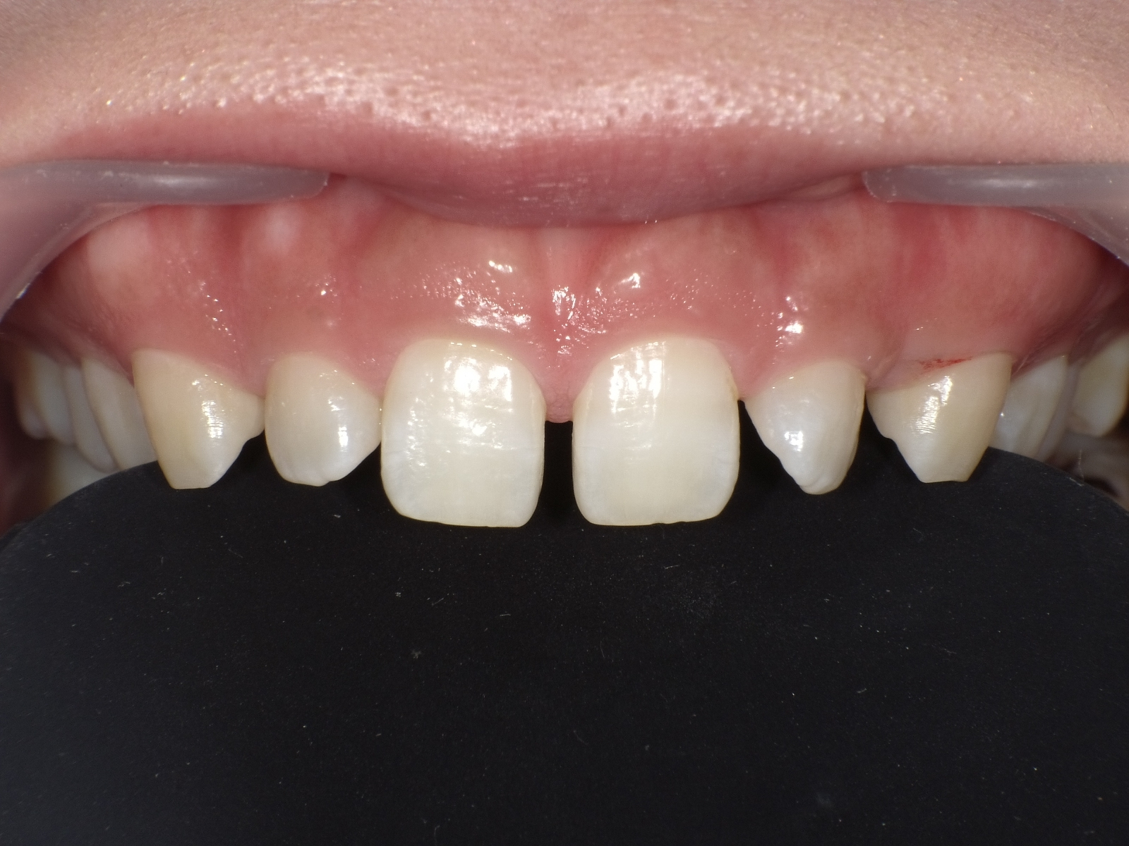 ダイレクトボンディング_30代女性_治療前