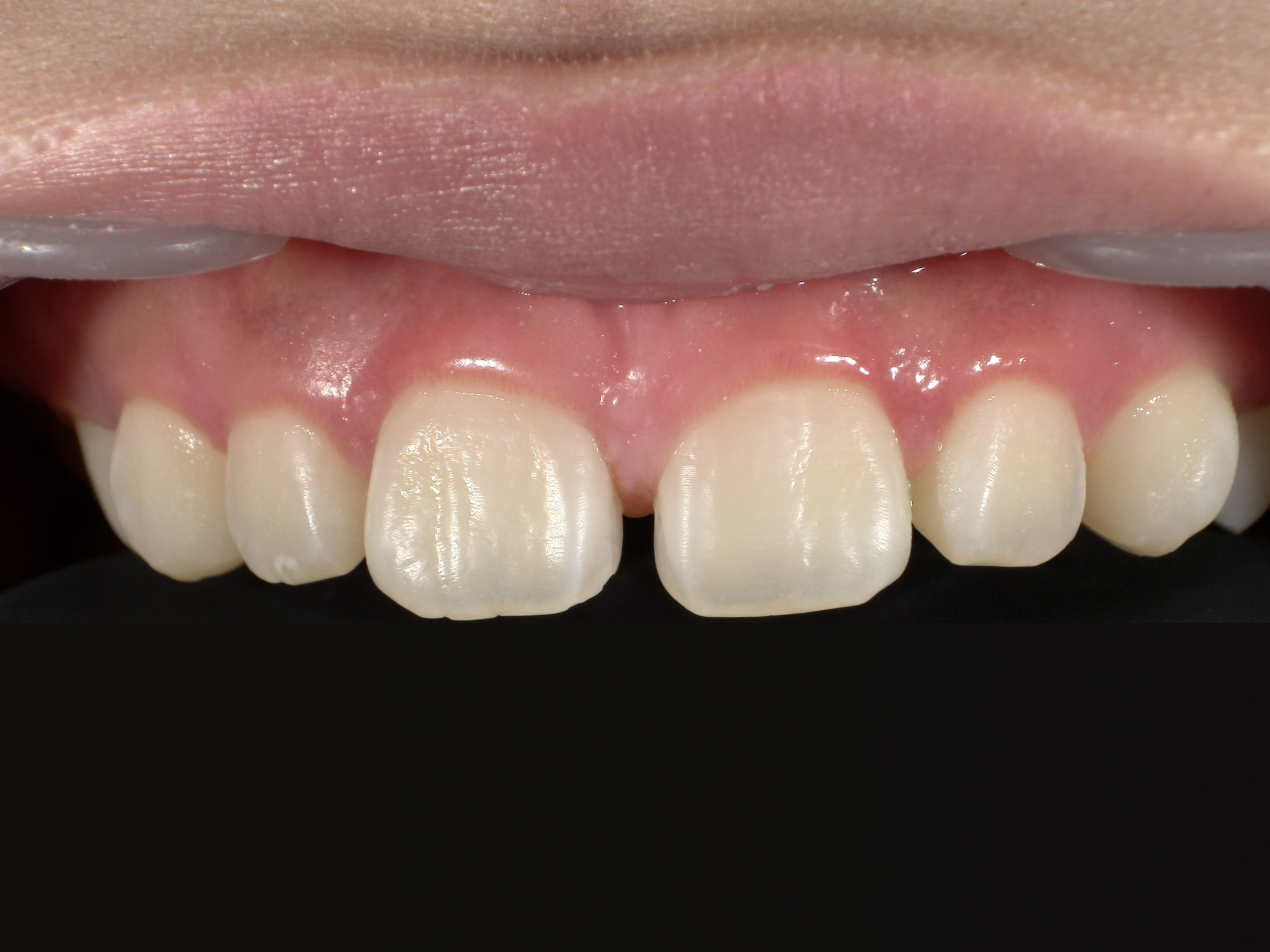 ダイレクトボンディング_10代女性_治療前