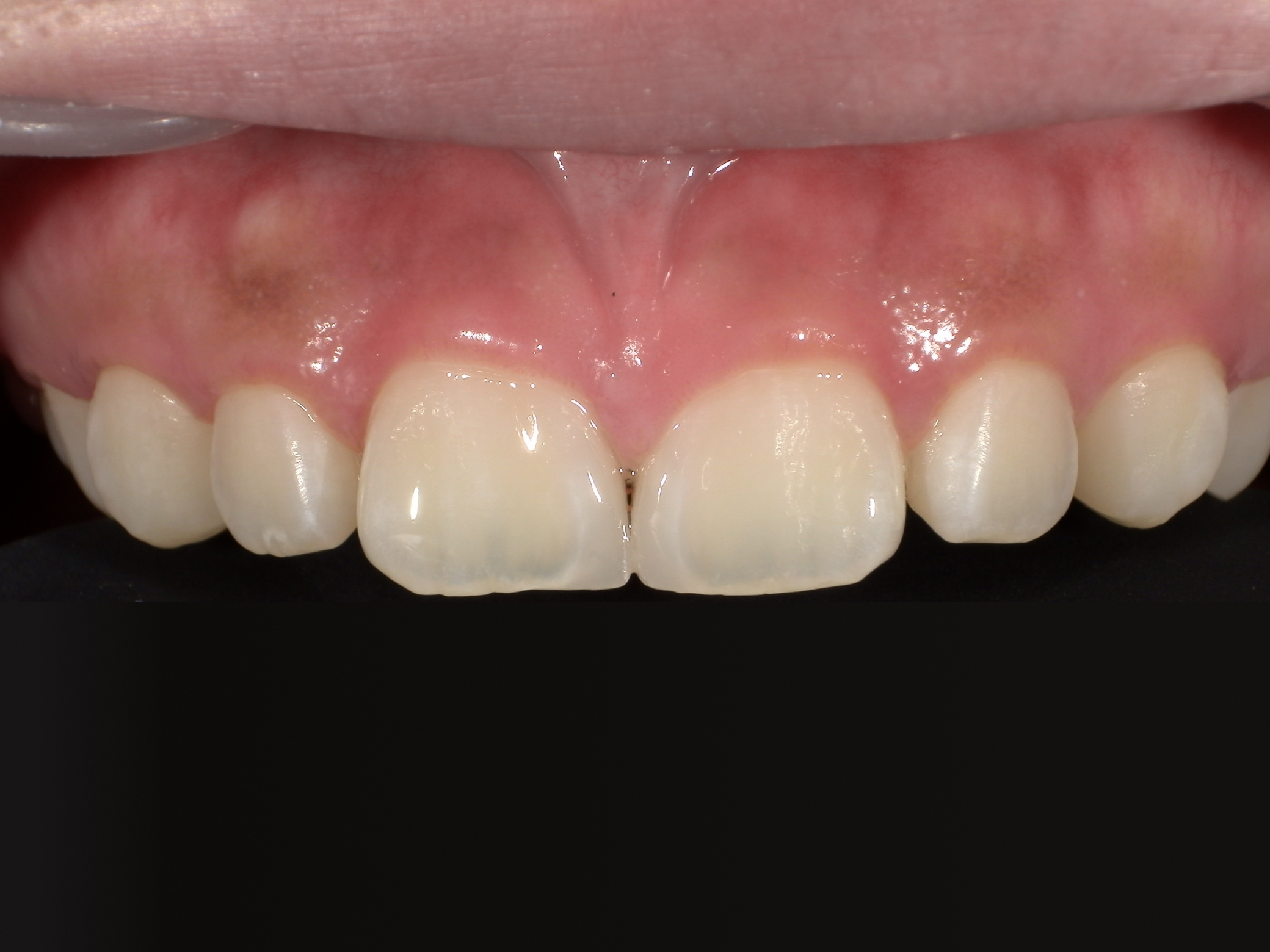 ダイレクトボンディング_10代女性_治療後