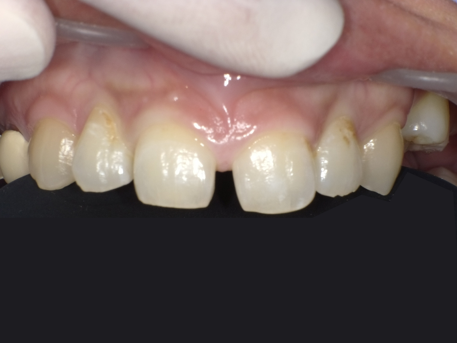 ダイレクトボンディング_30代女性_治療前