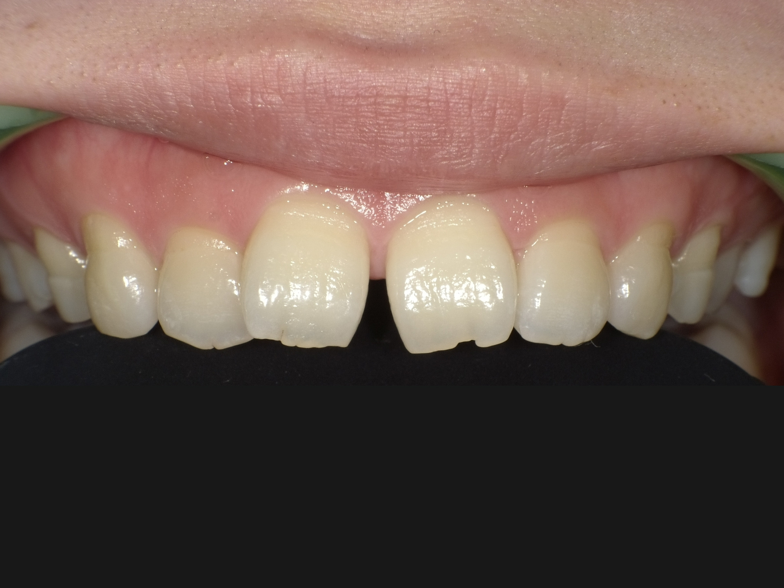 ダイレクトボンディング_20代女性_治療前