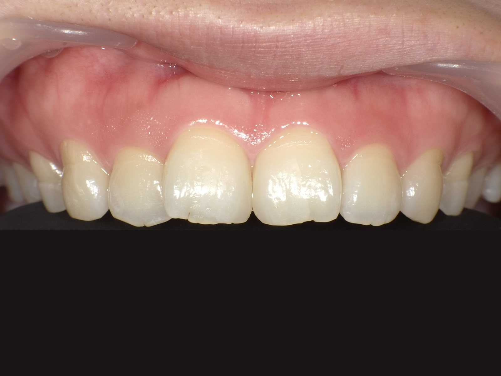 ダイレクトボンディング_20代女性_治療後